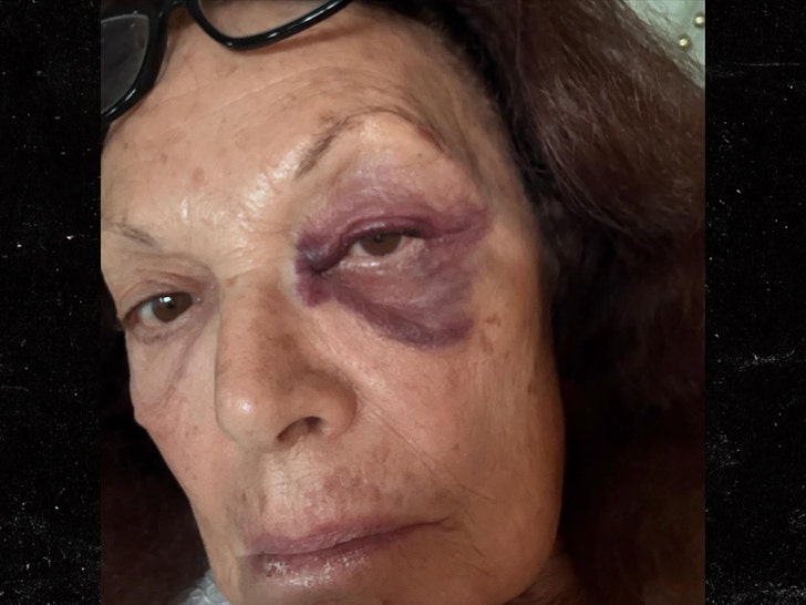 348c5bf761814b60bd60f0bbd05b03b4_md Diane von Furstenberg suffers black eye during fall