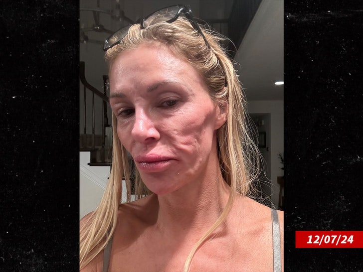 60b77e49a03f476b801927808696dc6a_md-3 brandi glanville dissolved face fillers x