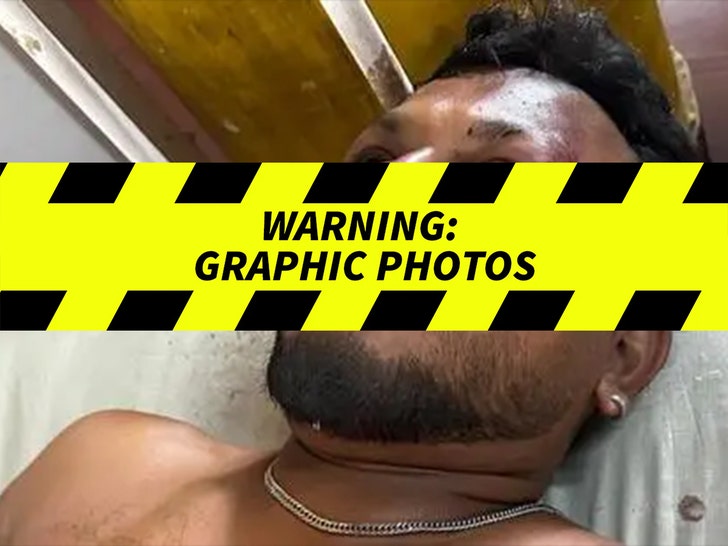 7c2315d1f93845f6a98c3aa7d2da024d_md British Survivor From Air India Plane Crash -- Graphic Injuries