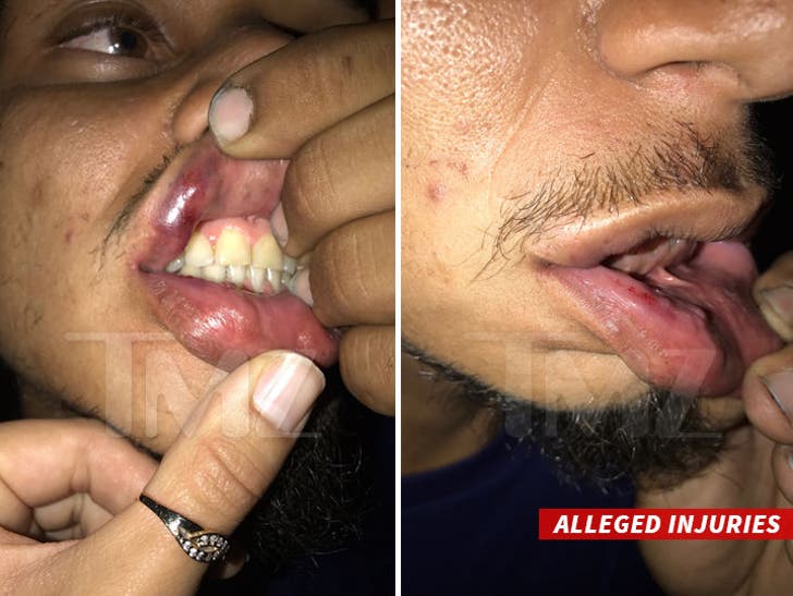 Chris Brown Accused of Punching Photog in Nightclub Brawl VIDEO :: 0417-chris-brown-victim-injuries-tmz-wm-3