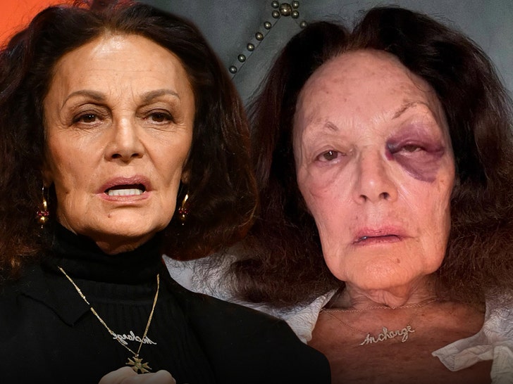 a2097dd4d996425c8791041aaf6de112_md Designer Diane von Furstenberg Suffers Gnarly Black Eye After Fall