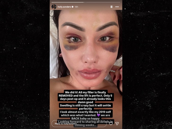 holly sonders removes fillers insta 1