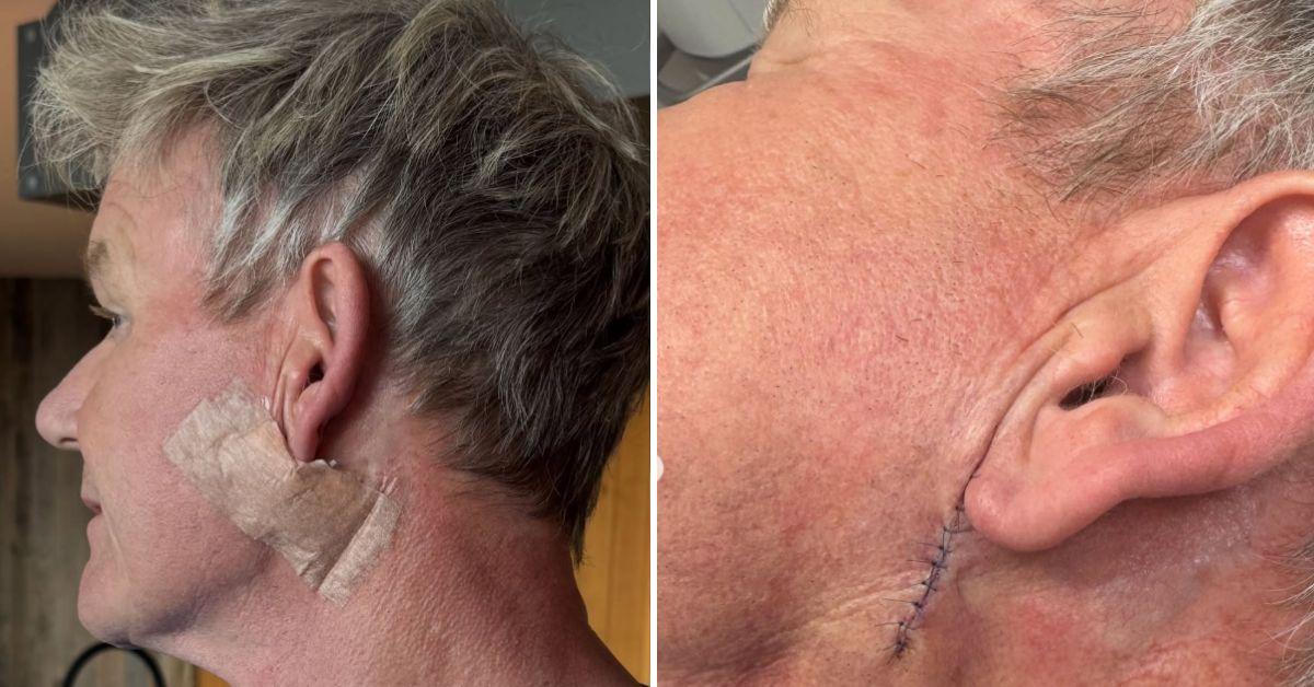 gordon-ramsay-cancer-tv-star-stitched-up-face-emergency-surgery-2-1756563536559 gordon ramsay cancer tv star stitched up face emergency surgery