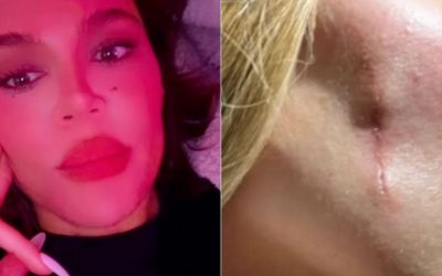 Khloé Kardashian Shares Horrifying Photos After Having A TUMOR Removed From Her Face Following Skin Cancer Scare