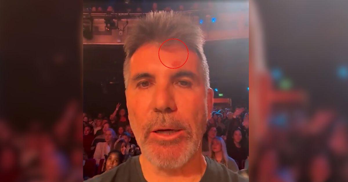 simon-cowell-bgt-bruise-1760722837550 photo of simon cowelll