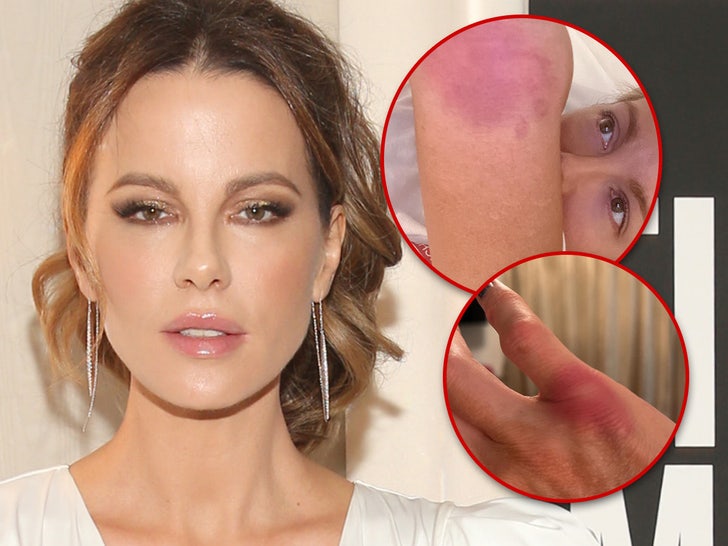 338debb185d04eab846a69e12d8b8d73_md kate beckinsale injury