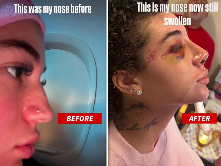 5ad5cb0ed98a4b70aebe6c68be3f760e_md Bhad Bhabie nose job before and after