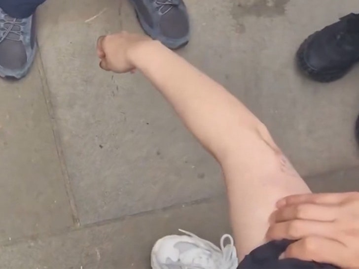 072224-horse-bite-arm