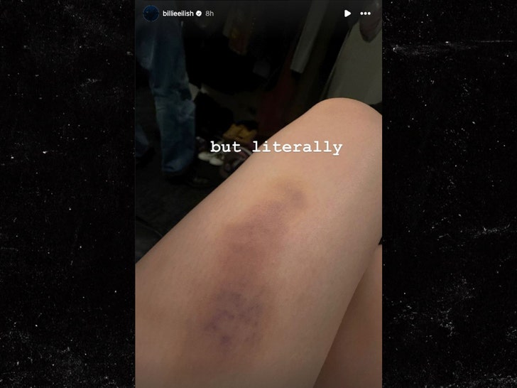 a7373553136a4b519e842095d3203702_md billie eilish leg bruise