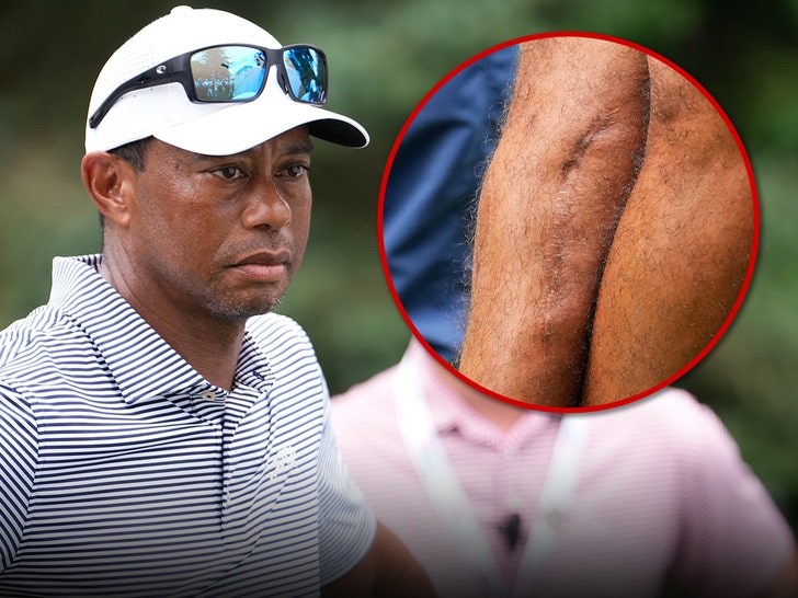 e622aa3b99c34c949eb678a1fd6c1fd9_md TIGER WOODS LEG SCAR