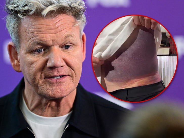 ec75de0dd5e9485e8b3f955a6988156f_md gordon ramsay bruise main getty comp