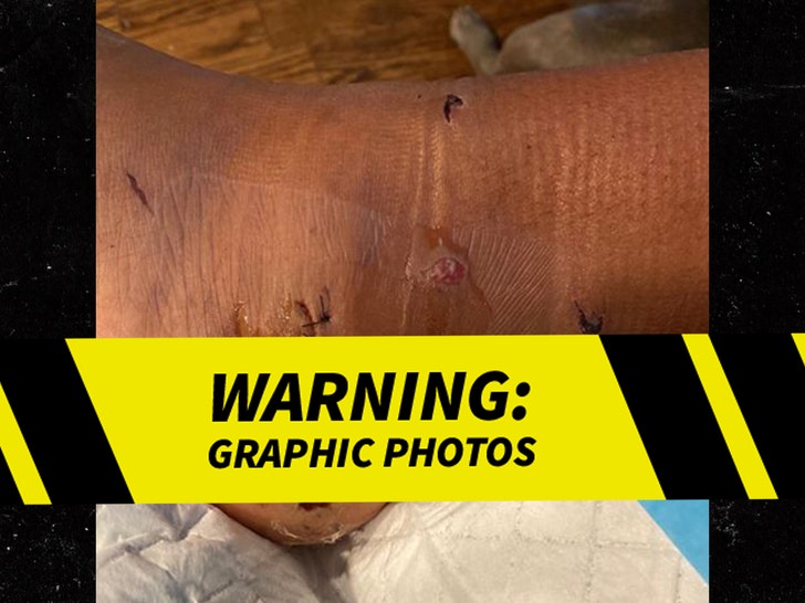 Meg Thee Stallion's Gunshot Foot Injury
