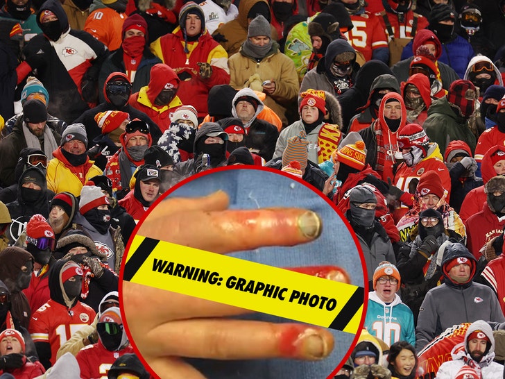 chiefs dolphins frostbite