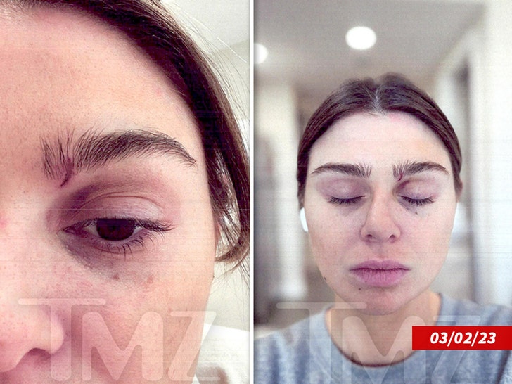 raquel leviss injuries