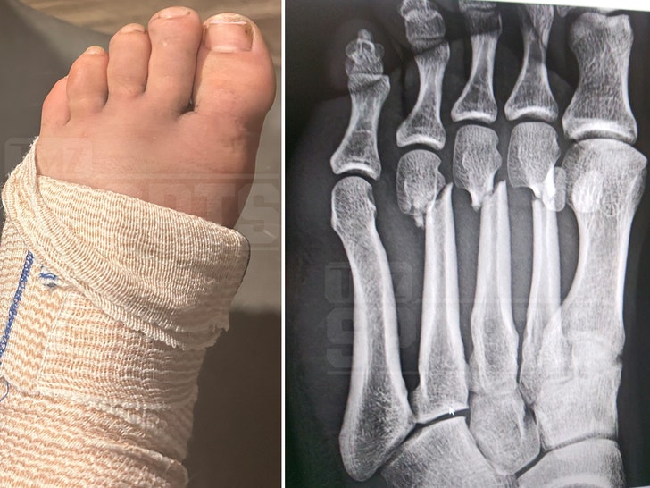 Darby Allin foot xray