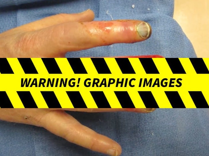 Kansas City Fans' Frostbitten Fingers