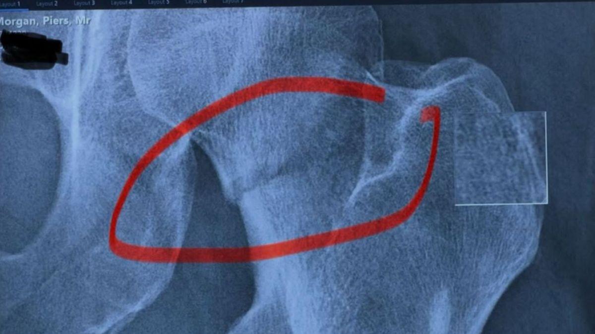 piers morgan hospitalized tripping restaurant shattering his femur