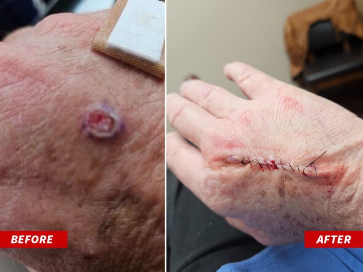 Michael Lohan hand cancer before afer