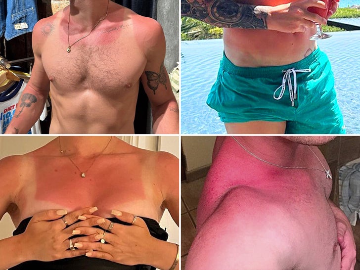 Celebrity Sunburns -- Guess Who!