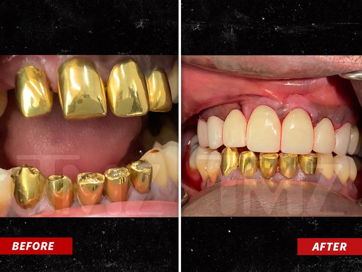 Tricky Daddy Gets 30 Year Old Gold Teeth Taken Out